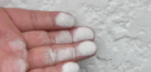 粉ふき（チョーキング）